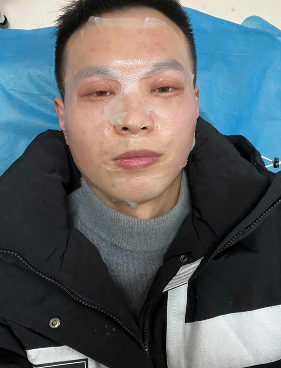 男人脸上长黄褐斑是一种正常的皮肤问题,针对这一问题,治疗黄褐斑已