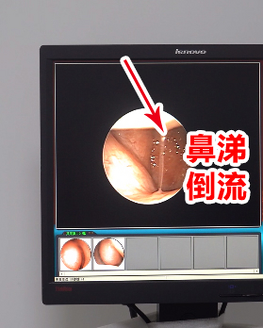 鼻涕倒流# 做手术,真心意义不大!