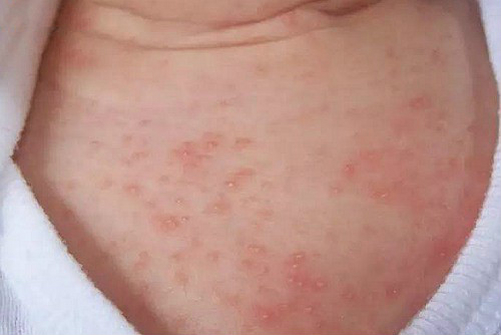 杭城皮肤病医院教你区分:天气越来越热,湿疹和痱子如何区别呢?