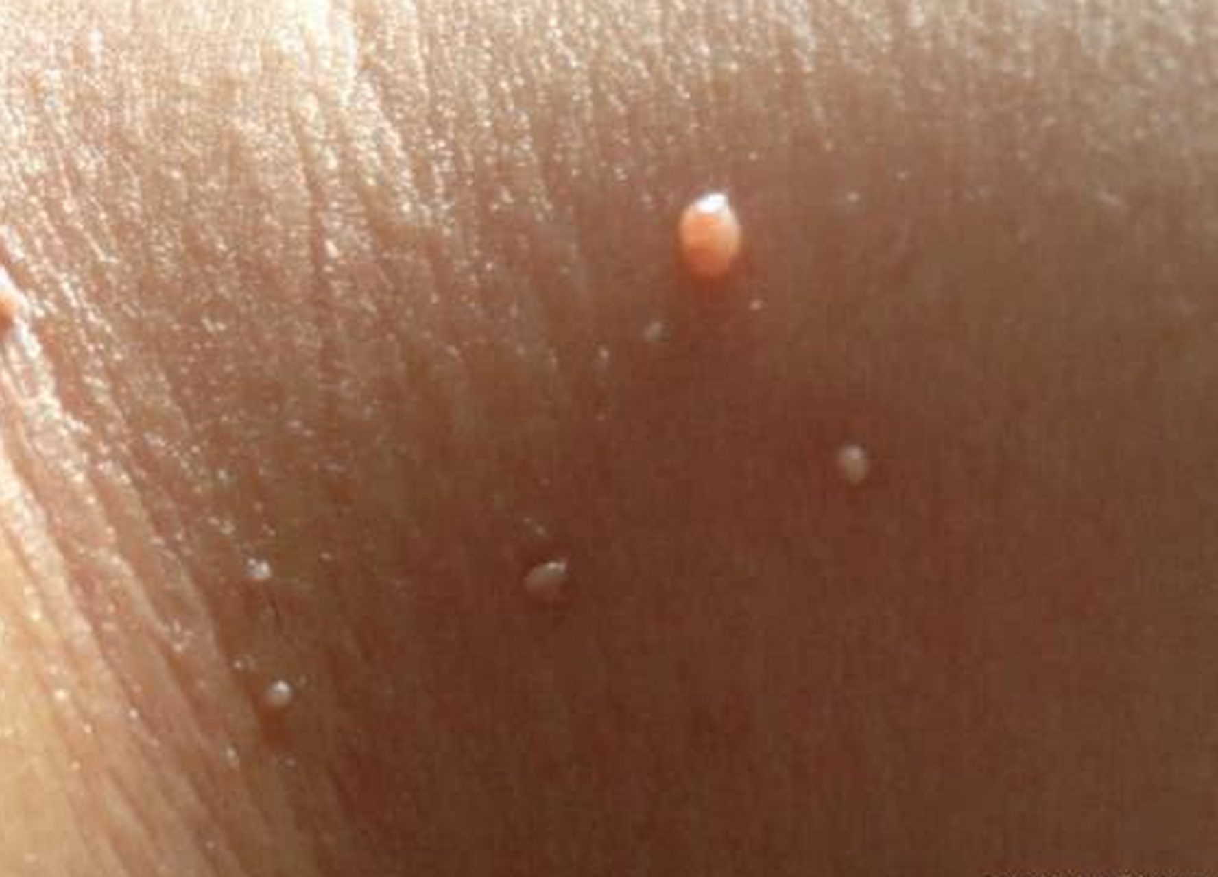 对象的脖子好奇怪,有好多小米粒,是hpv吗?