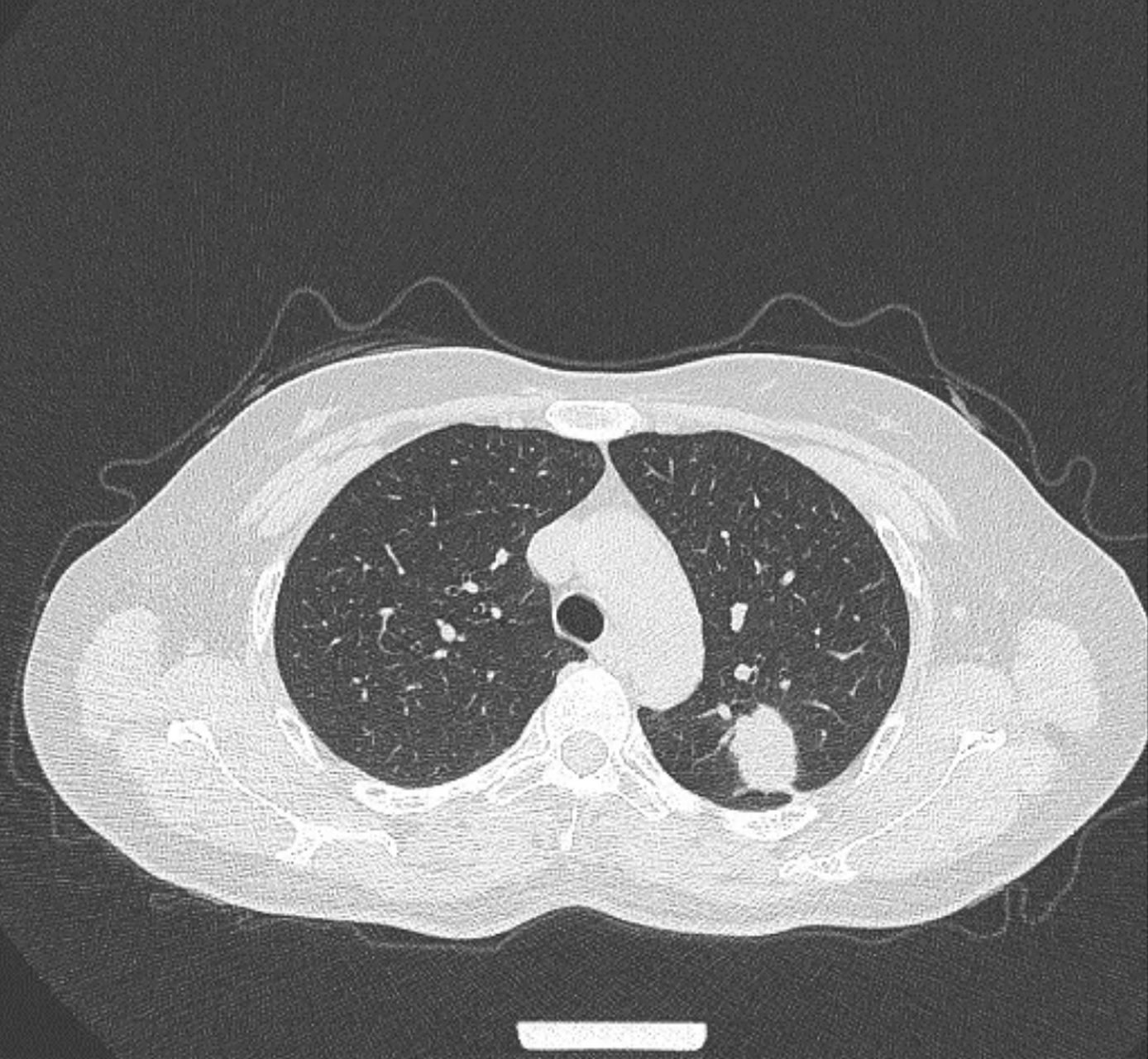 8厘米肺癌,4枚淋巴结转移 这位女士50多岁,不抽烟, 因为胸疼做ct检查