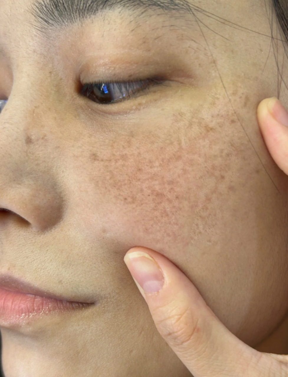 色素斑,是肌肤上的一种常见问题,给人们带来了不少困扰.它们的出现让