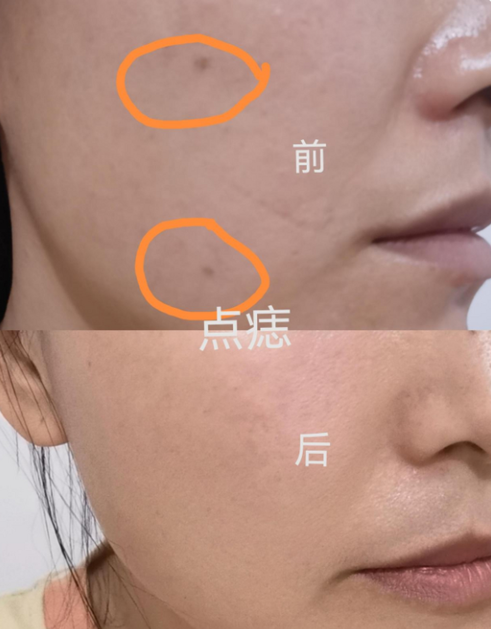 想要点痣但是不知道什么方法好,又怕会留疤,药水和激光都是可以