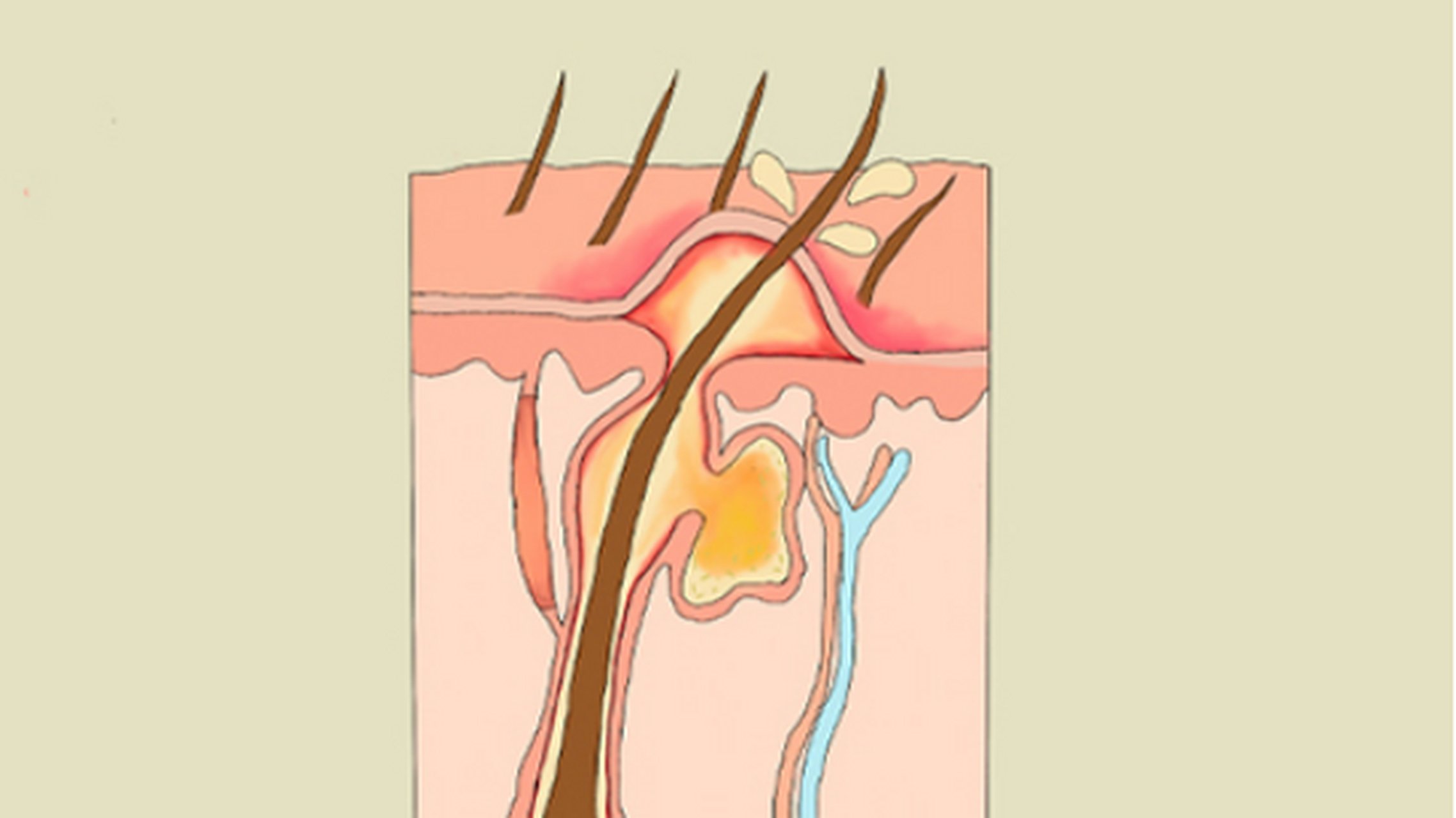 为什么久坐不动,容易引起毛囊炎?