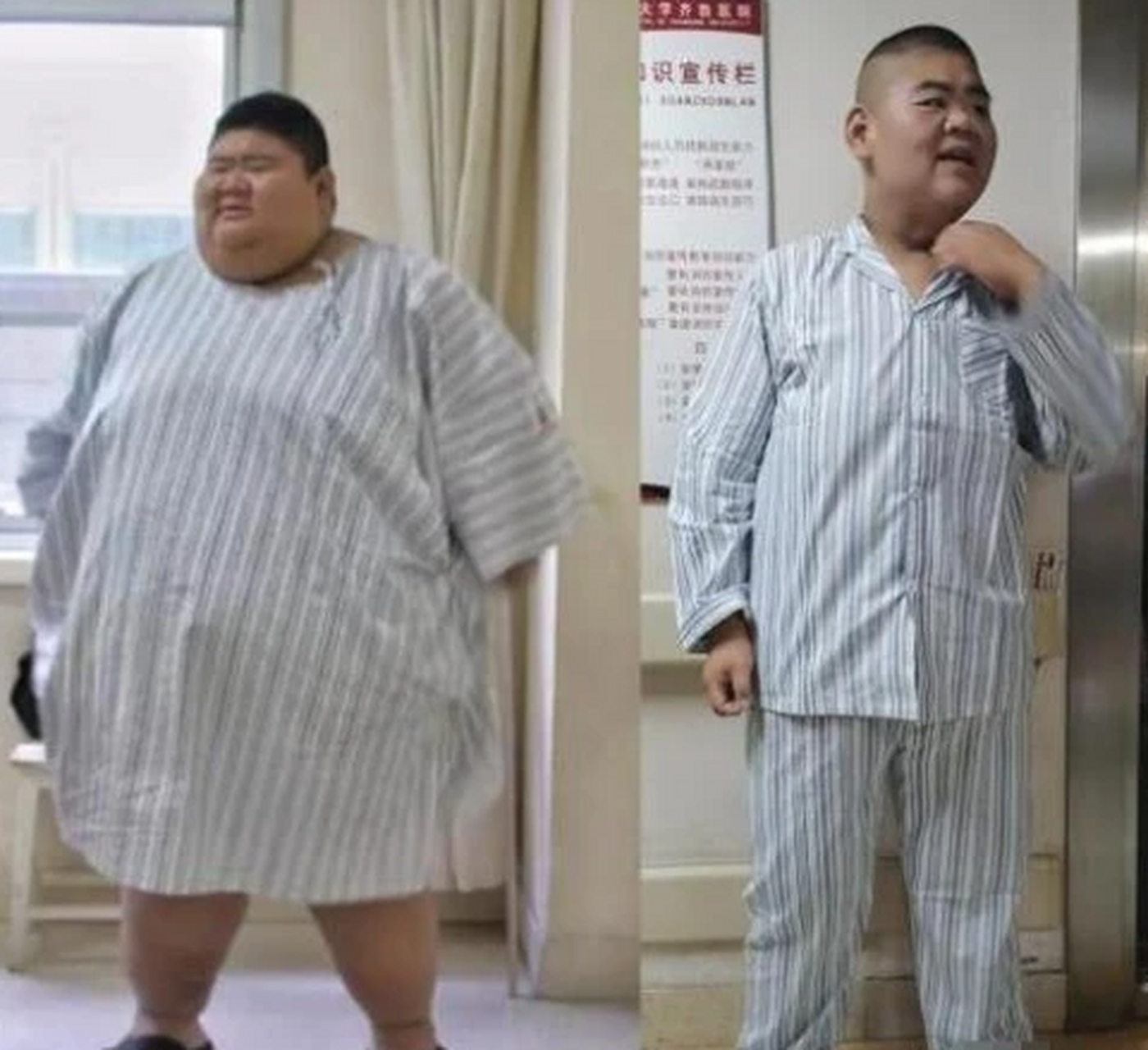号称"山东第一胖"的网红王浩楠,靠切胃减肥400多斤,如今又复胖了.