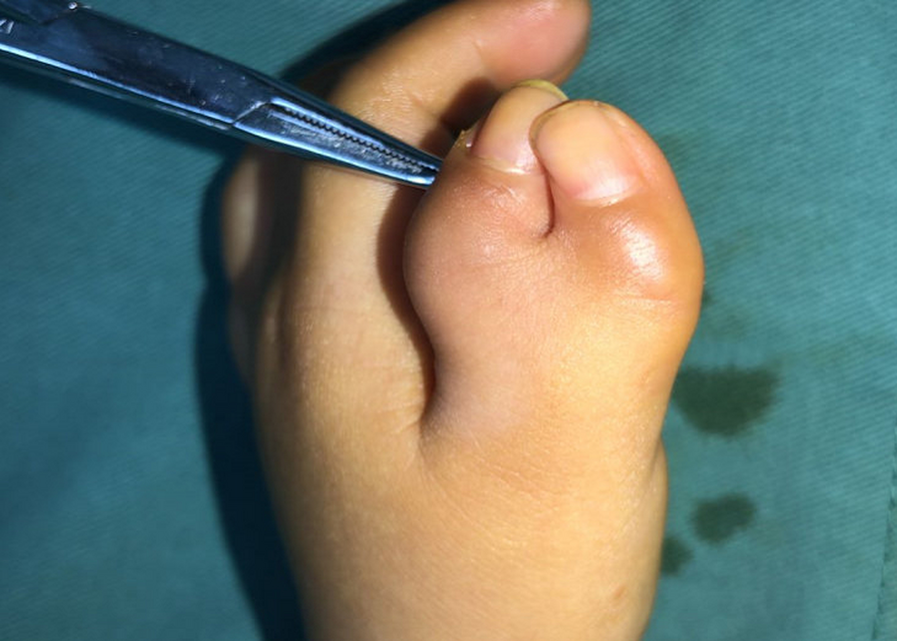 iv-d型复拇,俗称蟹钳样多指畸形,这类畸形的两个拇指像蟹钳一样,彩乔