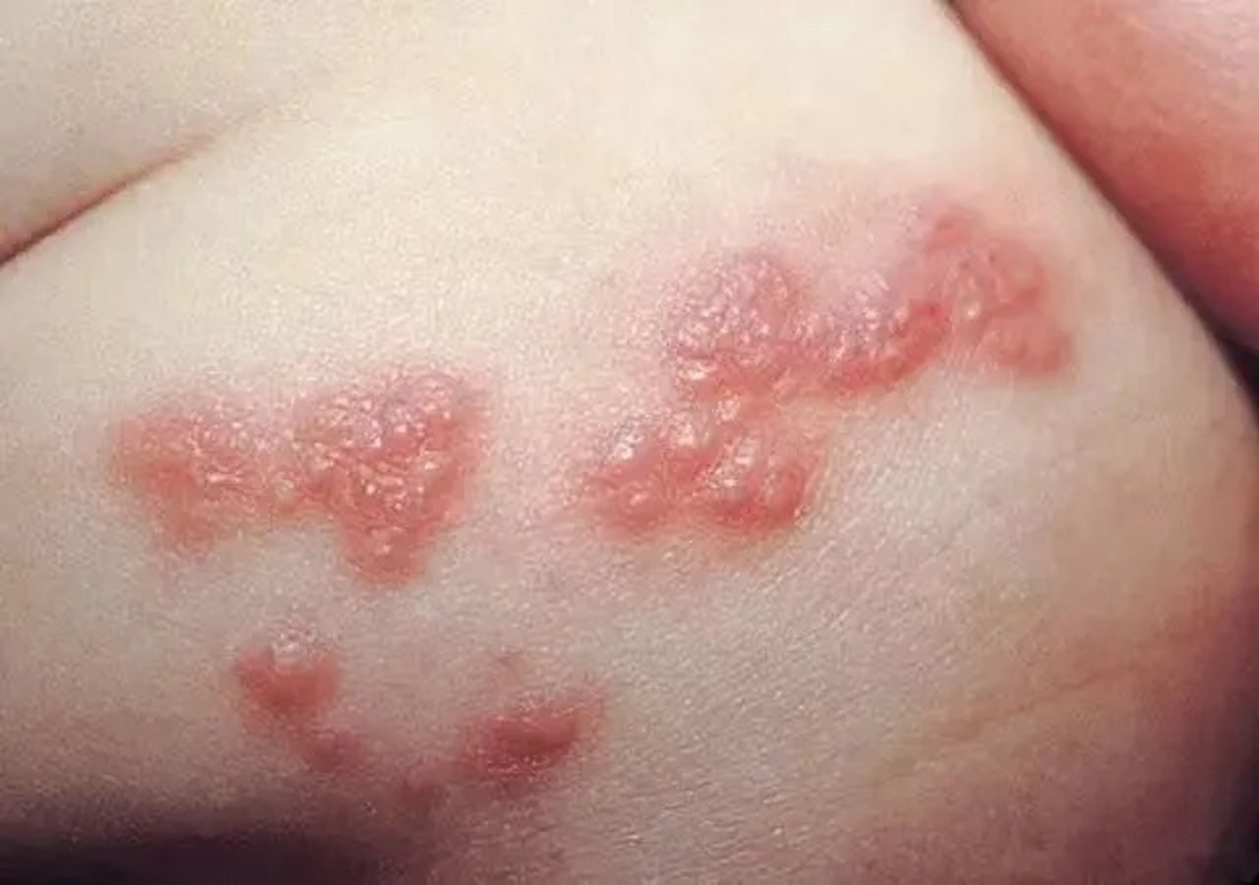 如果在儿童时期感染,得的就是水痘,但病毒可以在体内一直潜伏