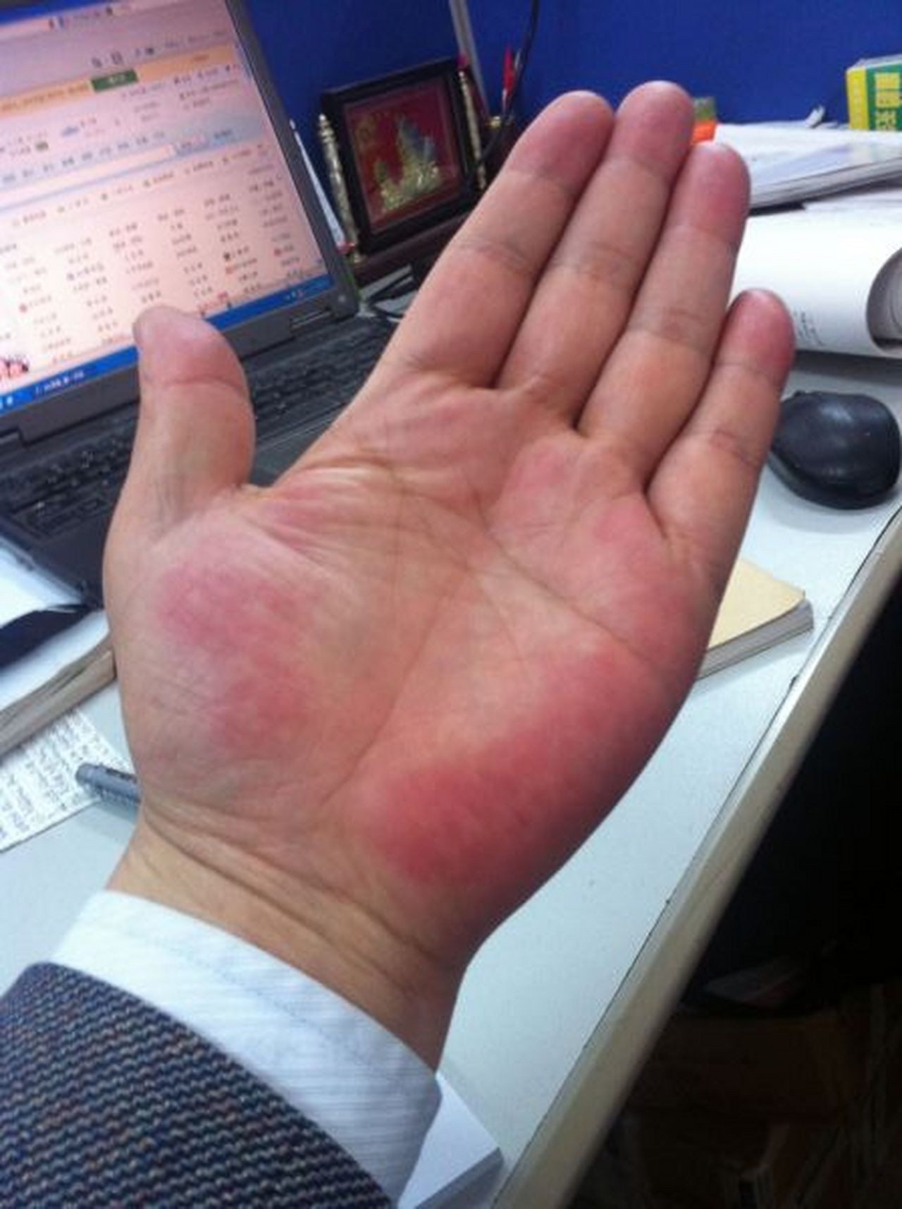 这就是典型的肝掌,可以看一下  一位乙肝肝硬化的病人,伸手问我这是不