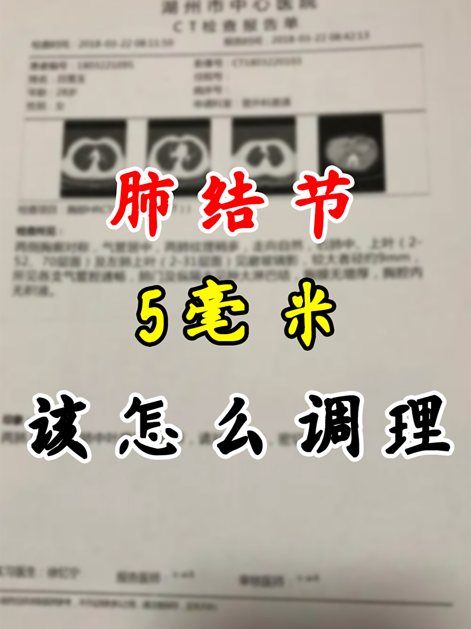 一位61岁的肺结节患者,右肺上叶有结节,显示是5mm磨玻璃结节.