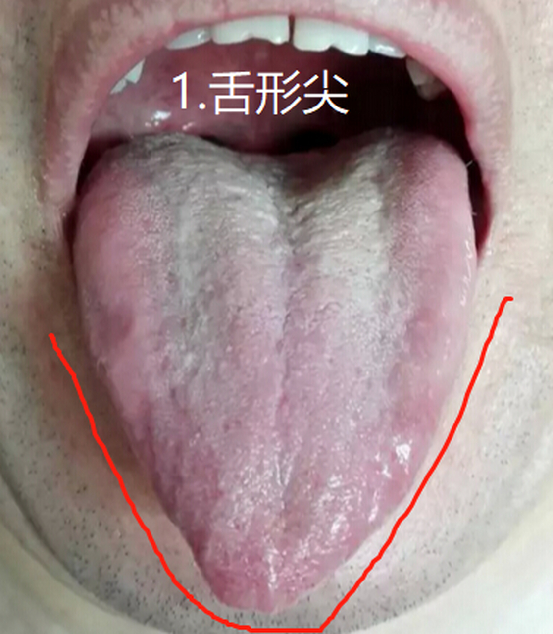 学习舌诊——肝郁舌象 气机失调:这样的舌象多在舌