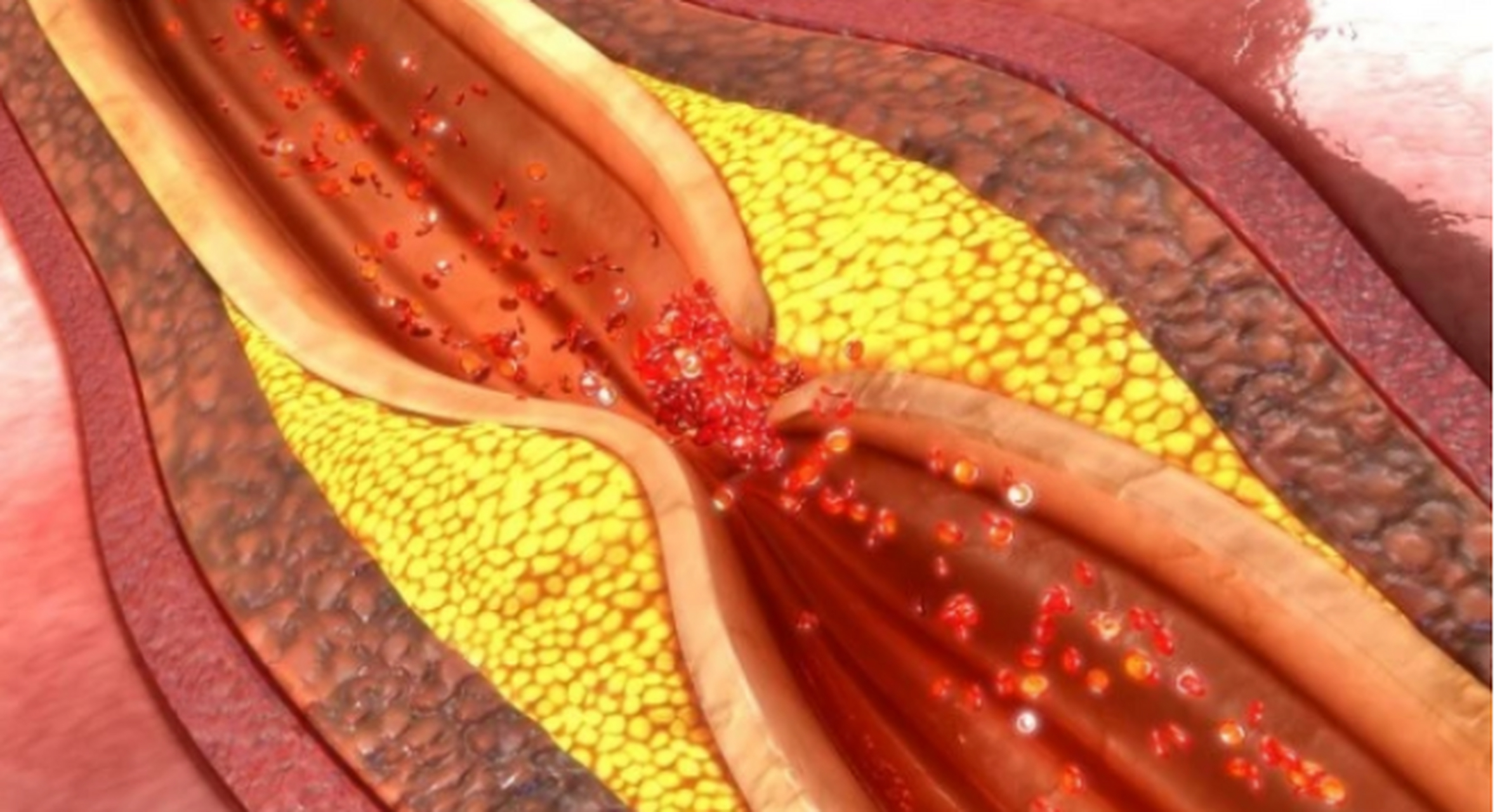 对付血管堵从不手软,农村遍地都是  大家好,我是吴翥镗,血管堵百病