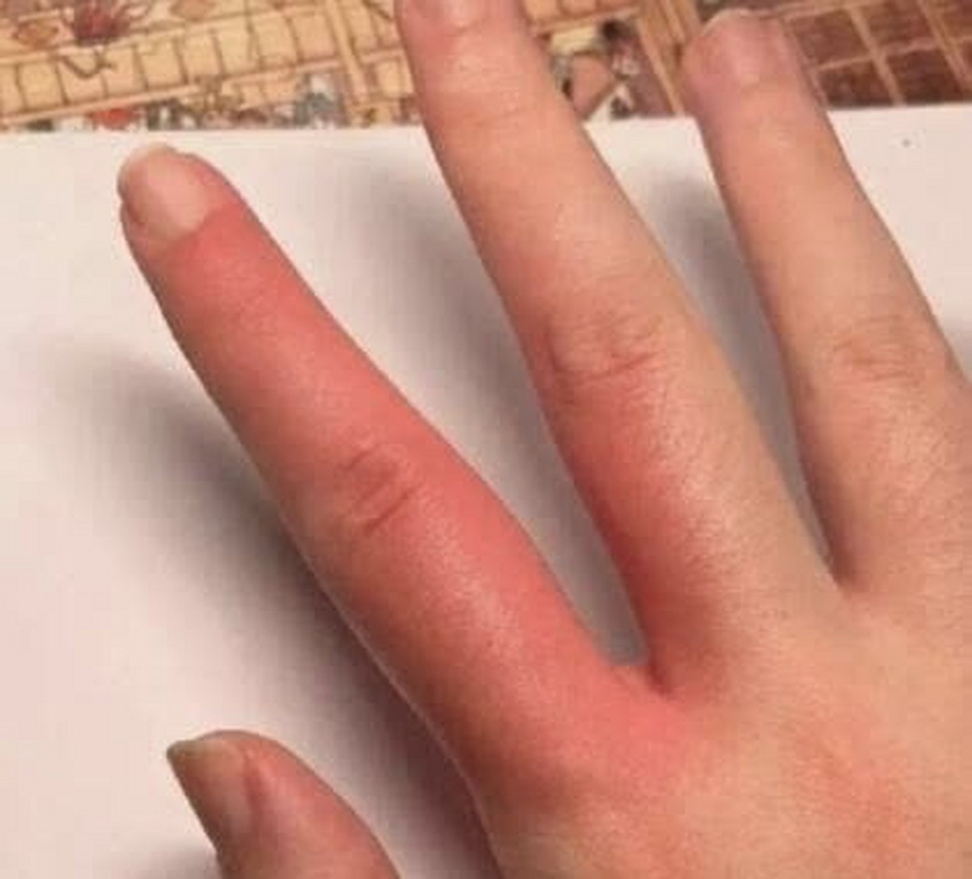 后续来了,手指有点肿,没什么大碍[大哈]