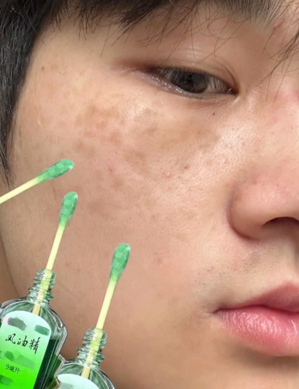 眼角长了一大块黄褐斑怎么办?