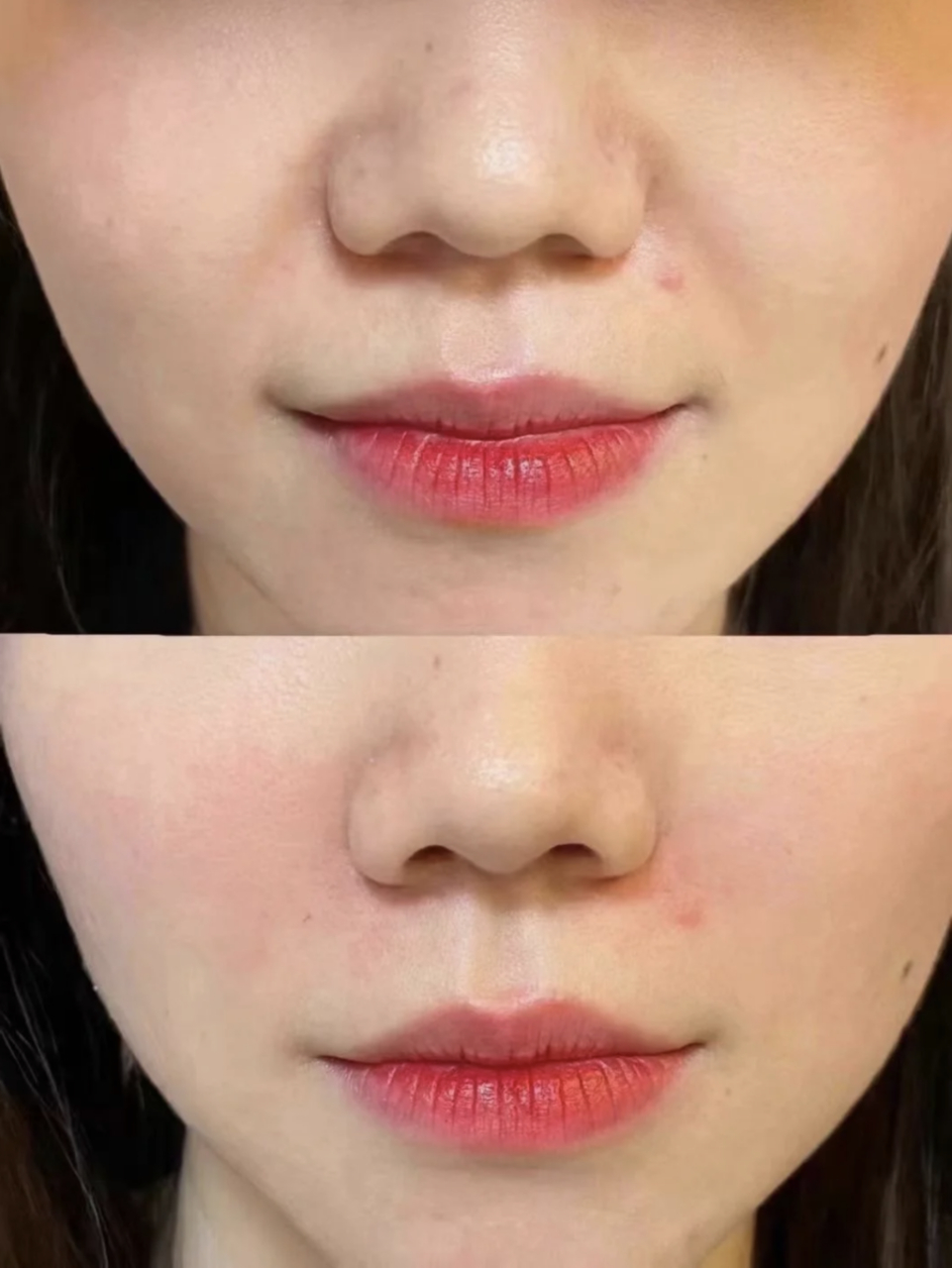 为什么鼻唇沟越来越凹,法令纹越来越深 鼻唇沟是面颊有动力软组织与无