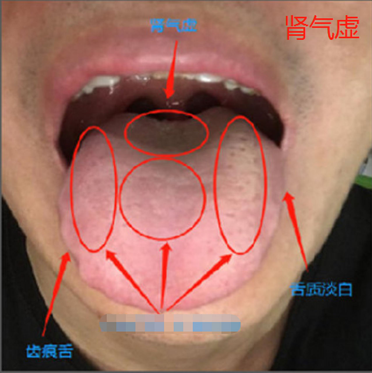 整理四种常见的肾虚舌苔,肾精亏虚,肾气虚,肾阳虚,肾阴虚,肾阴阳两虚