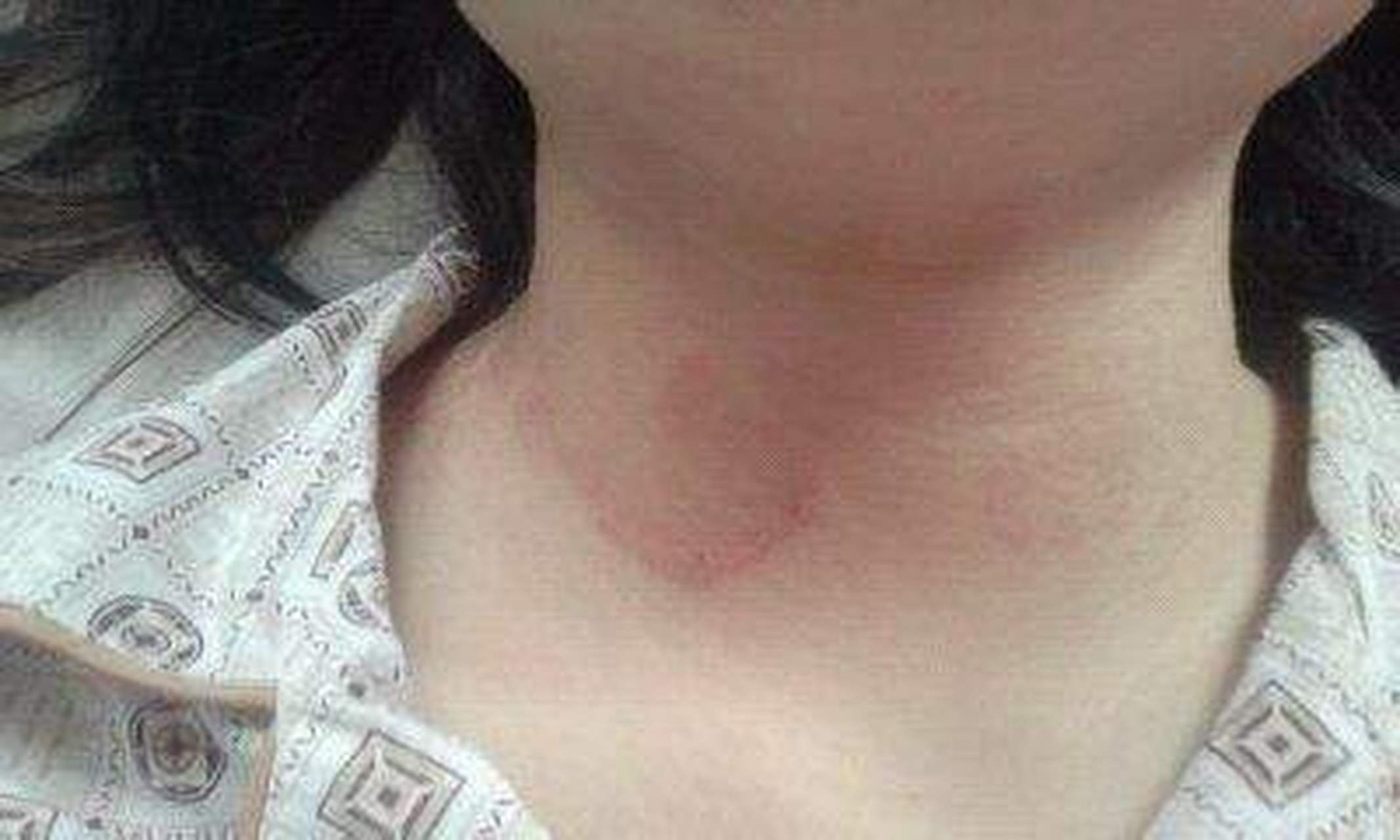 只有我自己知道应该是2年前的红斑狼疮复发了,可为何消退的红斑会