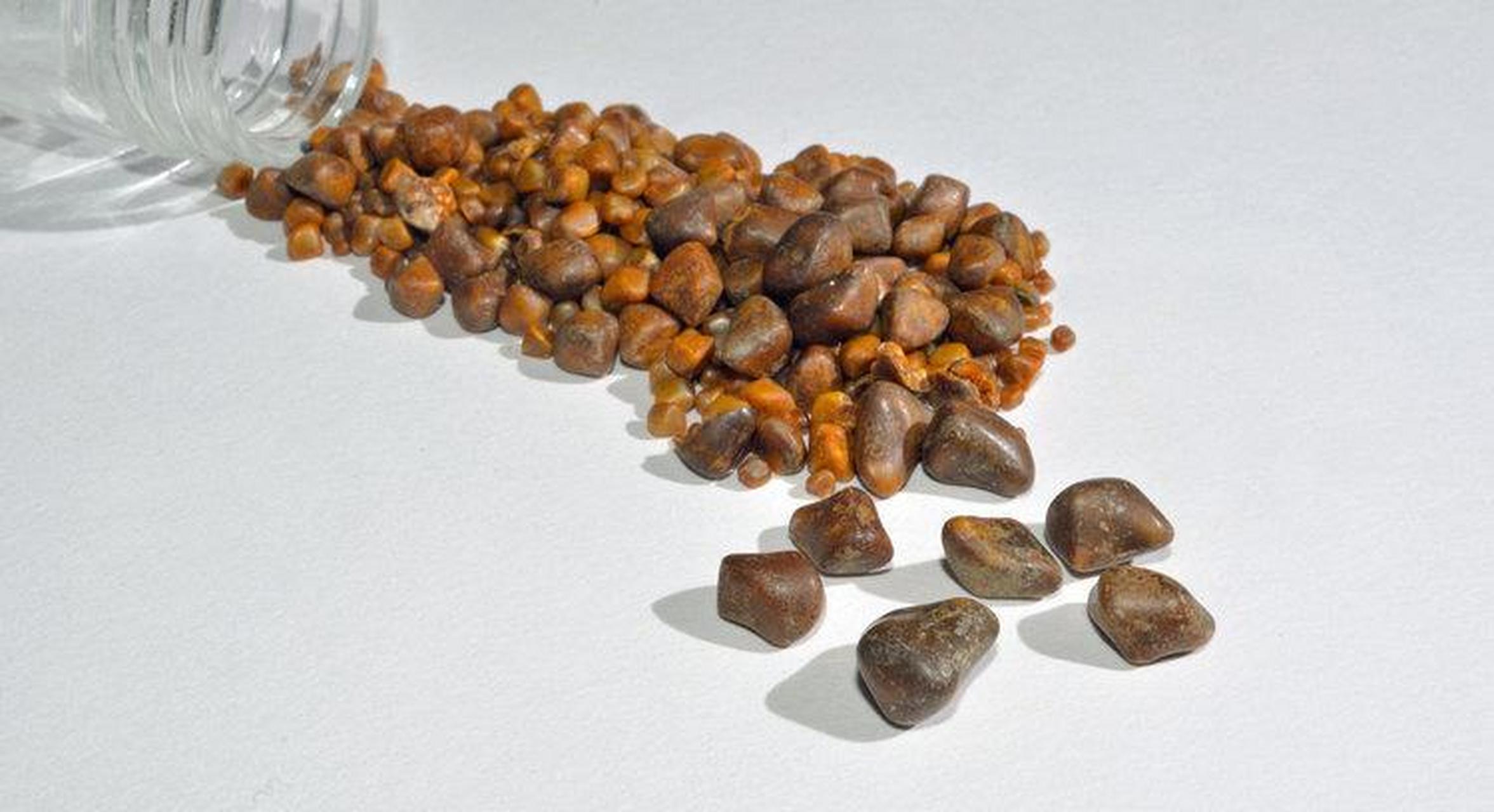 对于肾结石患者来说,很多人都选择了放任治疗.