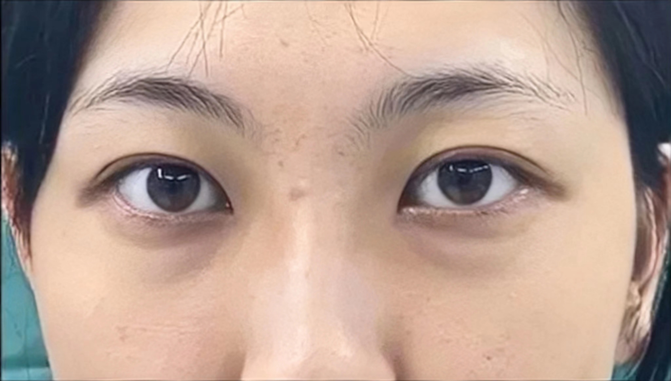 泪沟去除术——给眼袋脂肪重新安个家 【青春型眼袋与泪沟的组合】