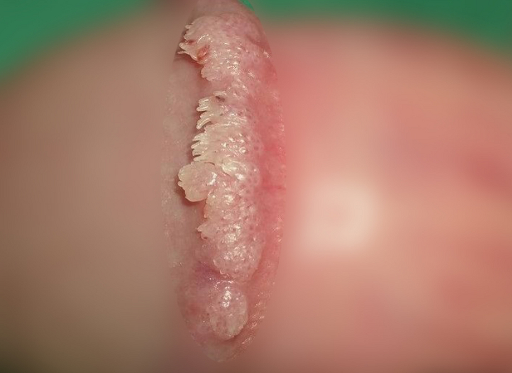 尖锐湿疣的特点就是容易反复出现,这也是我们治疗的主要挑战.