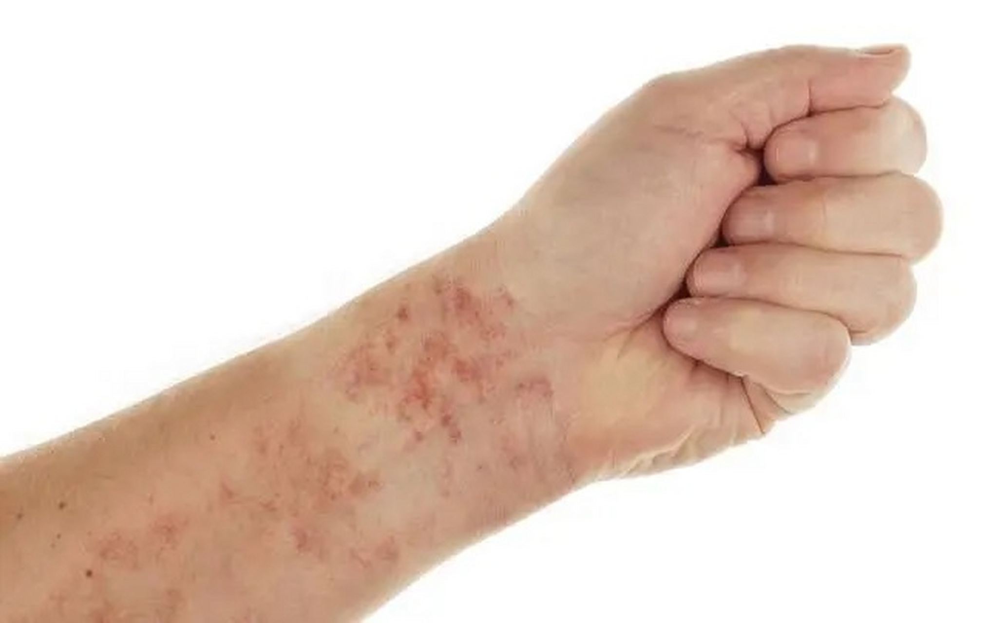 血小板减少性紫癜和白血病有什么区别?