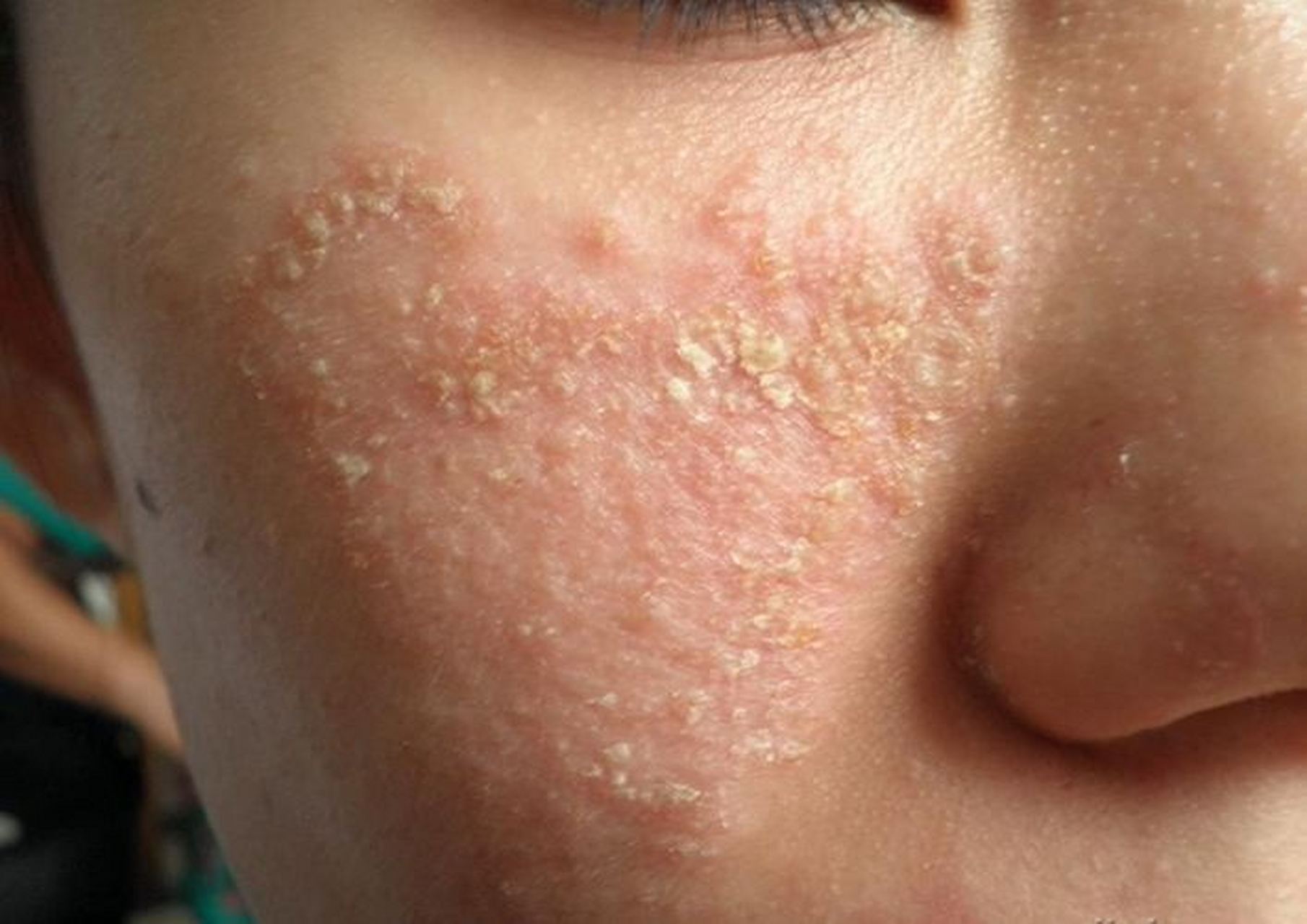 脂皮三年还有没有救?