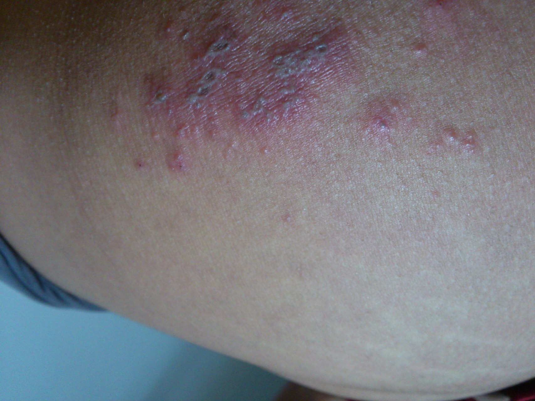 屁股上长了小疱以为是蚊子咬的,等抓破有渗液时去照镜子看了一下,结果