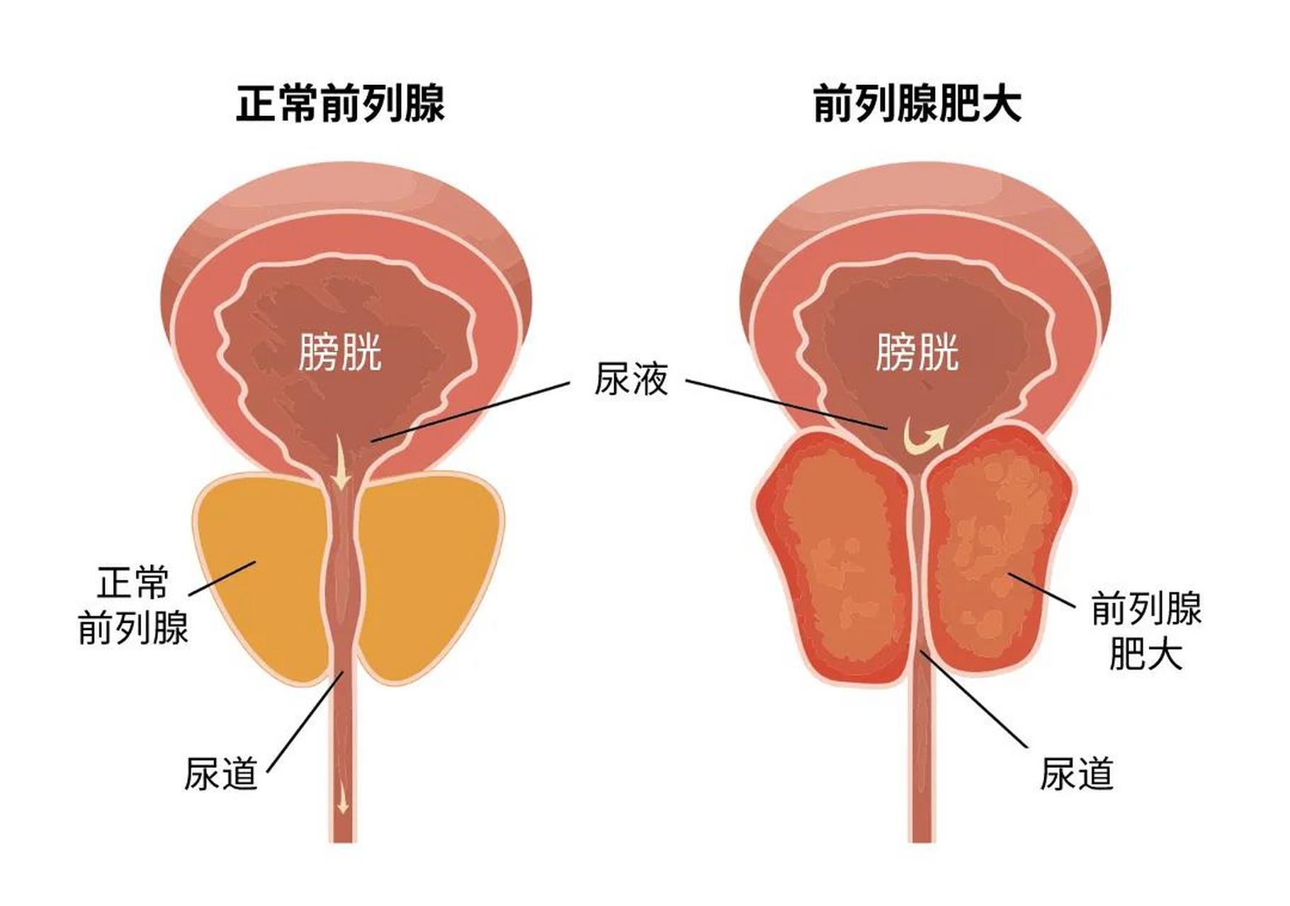前列腺炎的临床表现,归结有这3大类,男性朋友要注意.