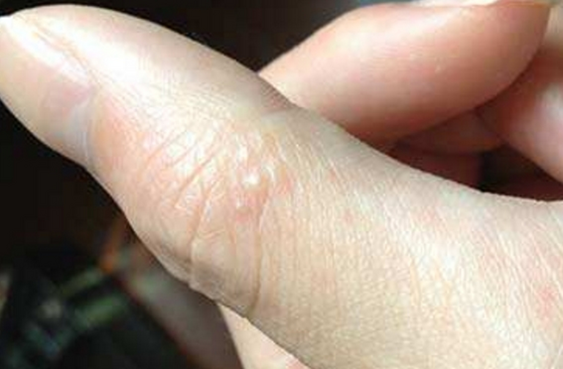 手上莫名长这种透明的"小水泡",很多人以为是上火,其实是身体在"求救"