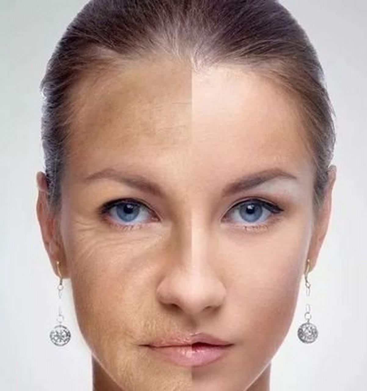 皮肤受到外力作用,真皮和皮下纤维组织弯曲,断裂,萎缩,使皮肤表面