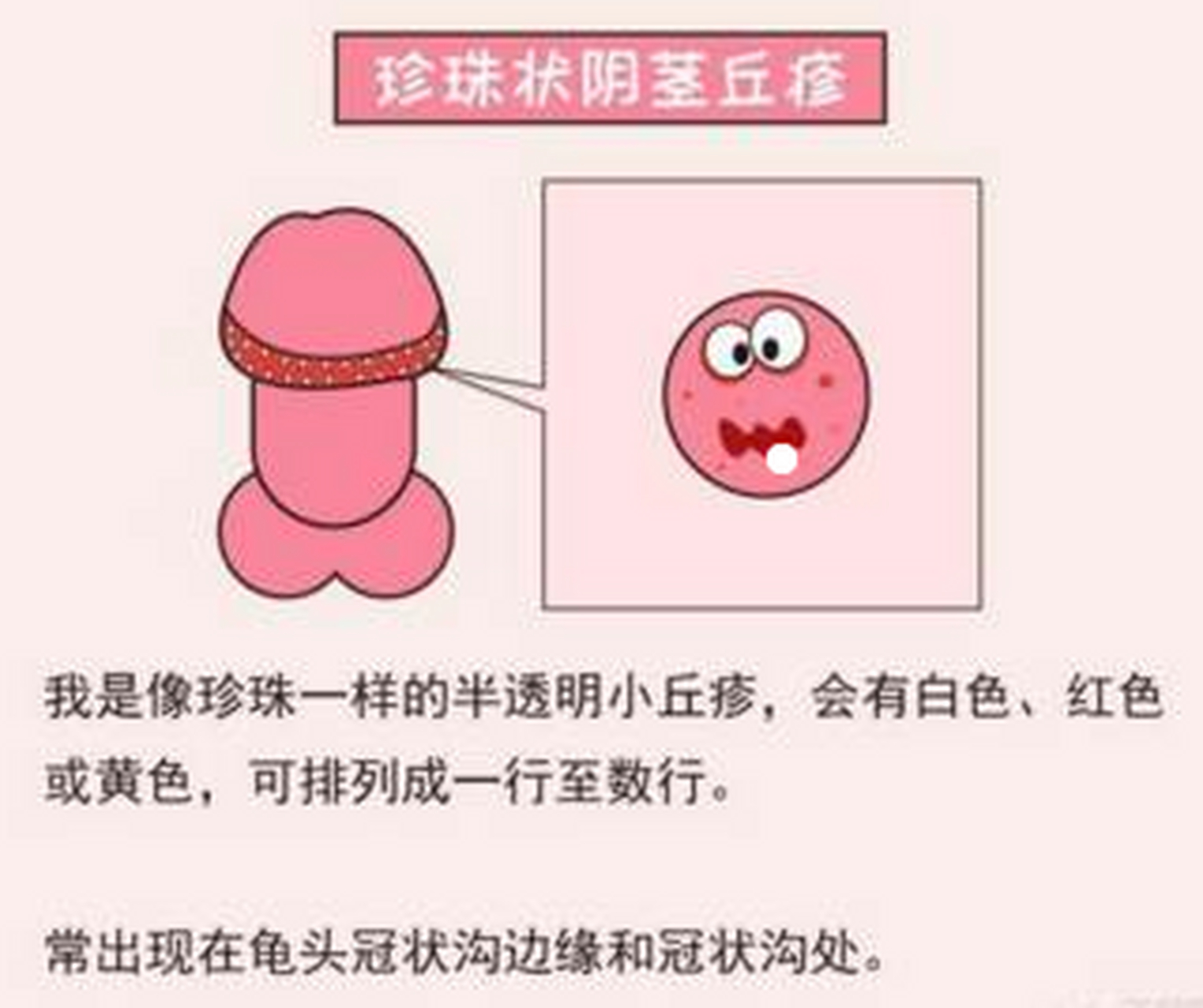 丁丁上的小疙瘩,不都说是"#疣#"吗?