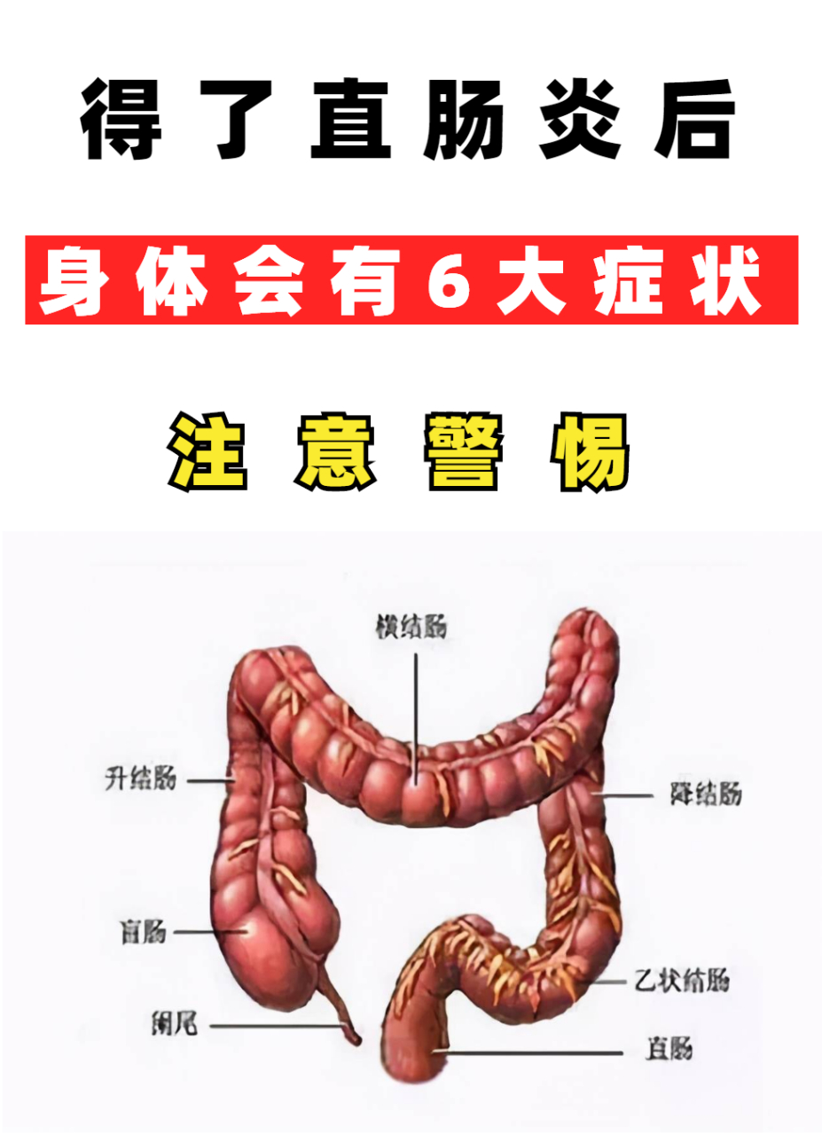 直肠炎怎么治疗图片