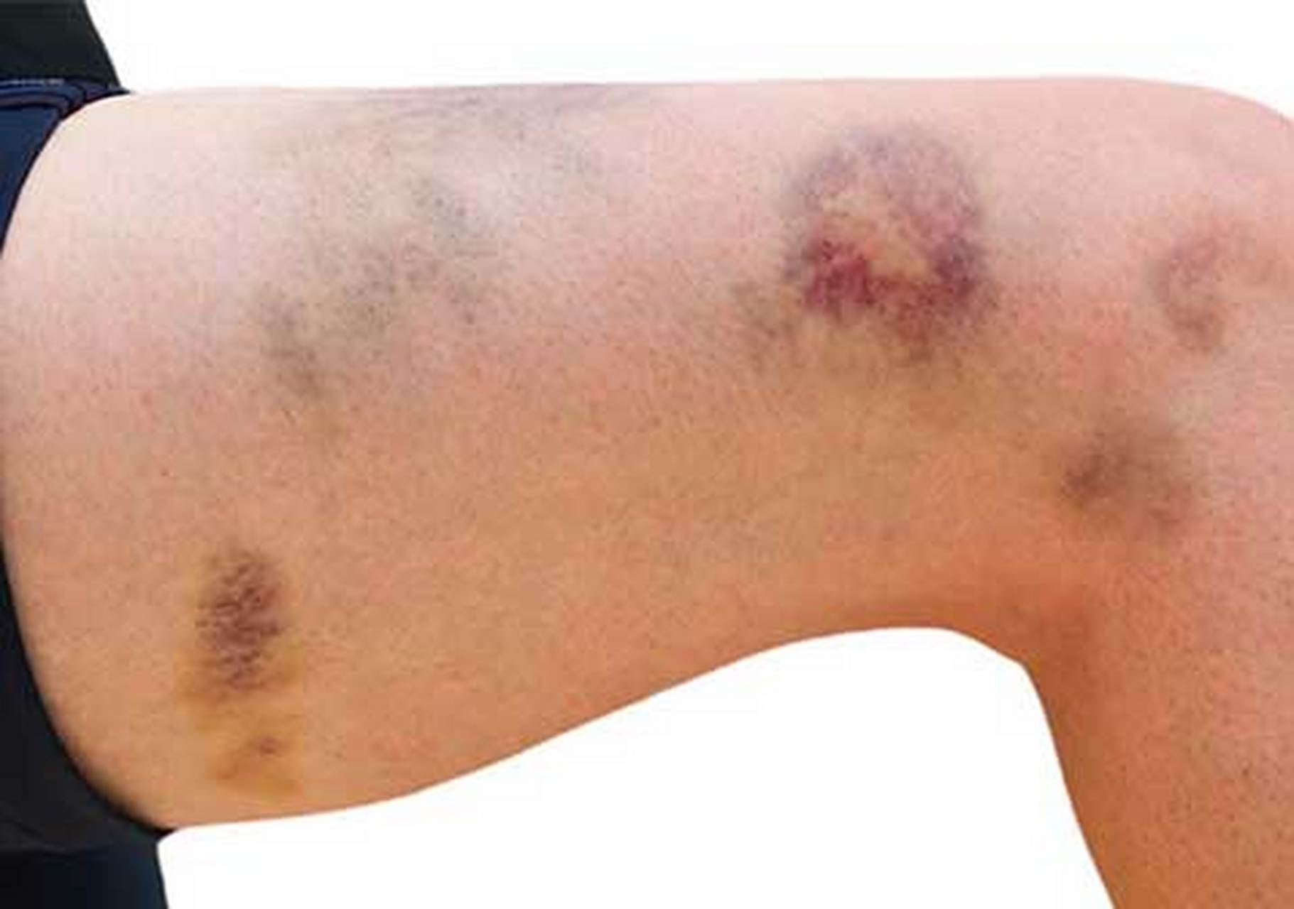 皮肤出现瘀斑淤点,可能是这3种疾病导致的!    1