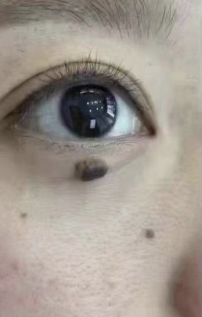 激光点痣# 哭痣怎么去掉 哭痣,或者叫做泪痣,是长在太阳穴和胫骨赘哌