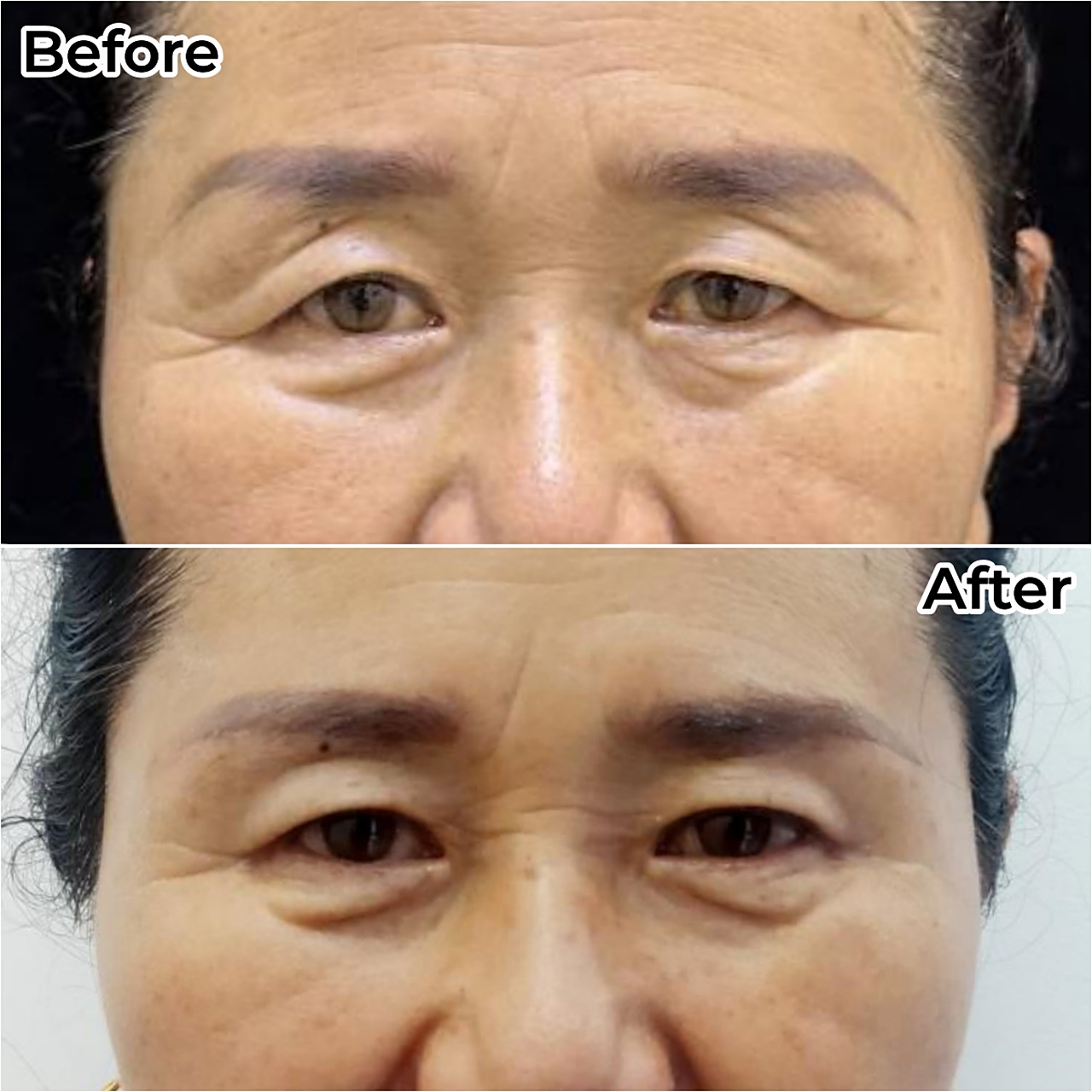 随着年龄的增长,皮肤逐渐松弛,导致眉毛下垂,给人一种憔悴的印象.