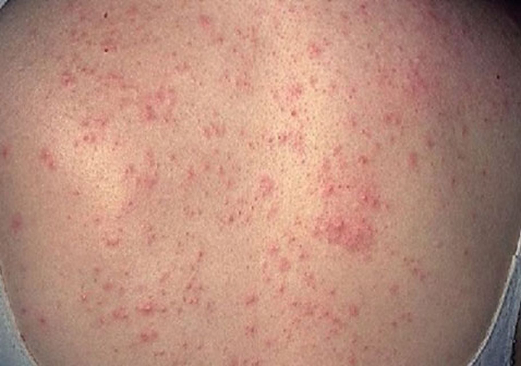 光敏性皮炎# #皮肤病# 光敏性皮炎主要是由于患者皮肤对太阳光产生