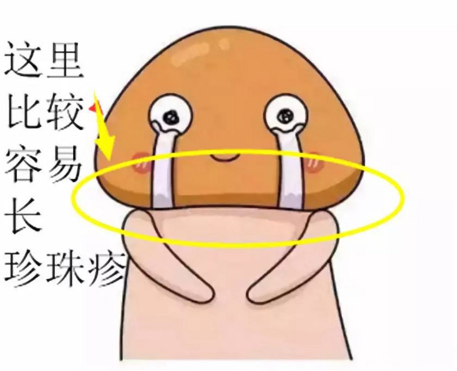 珍珠疹#珍珠疹# 是指珍珠状阴茎丘疹,通常情况下,珍珠状阴茎丘疹不