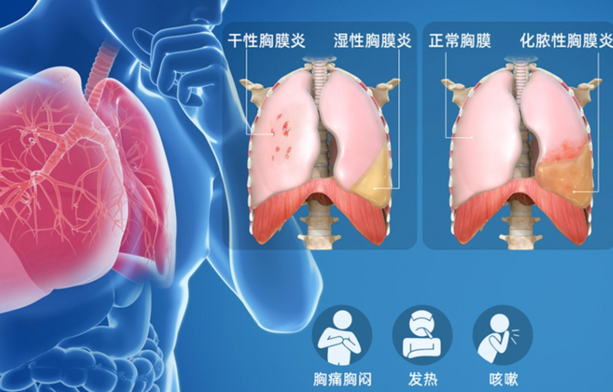 胸膜炎是由于各种病原体对胸膜造成的一种炎症反应,也被称为"肋膜炎".