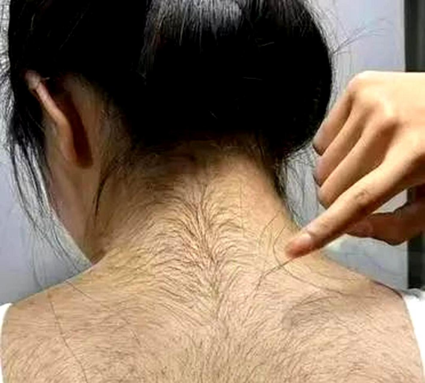 妻子的雄性激素水平过高,是否正常?