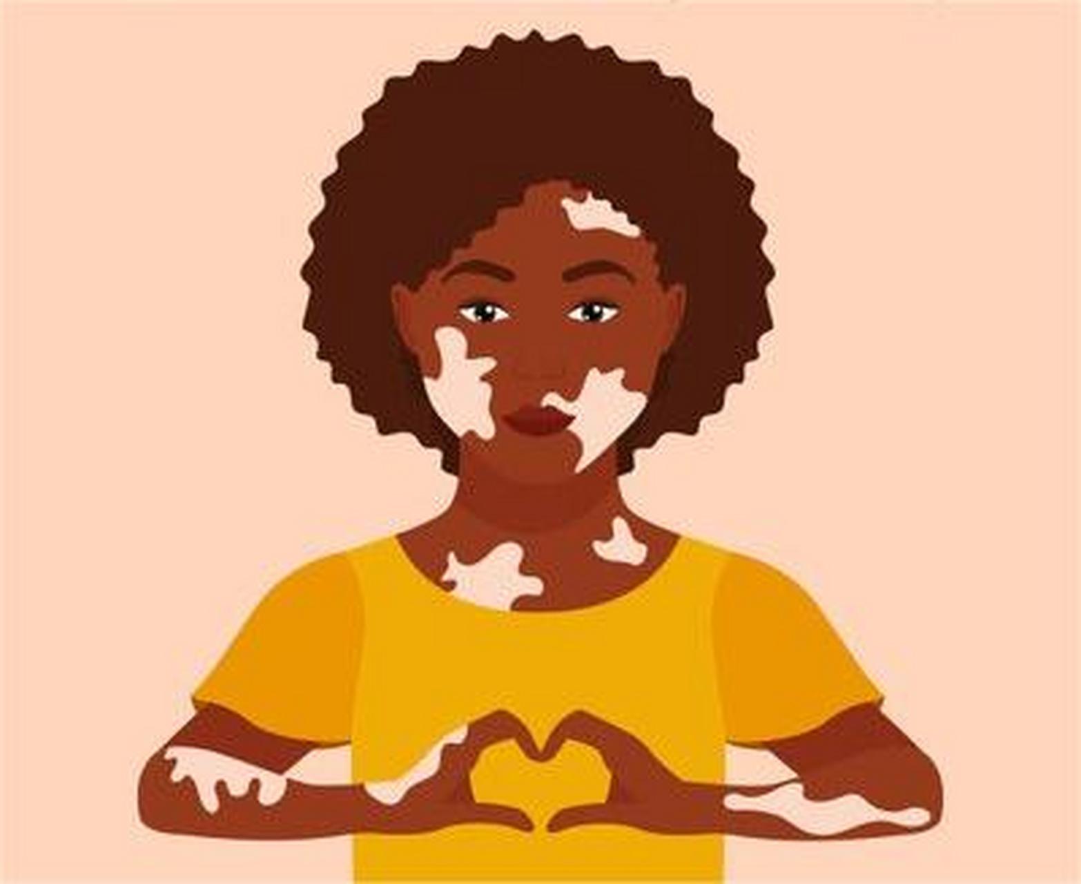 儿童白点癫风患者吃什么补充黑色素【增加黑色素食物】白癜风的豺因