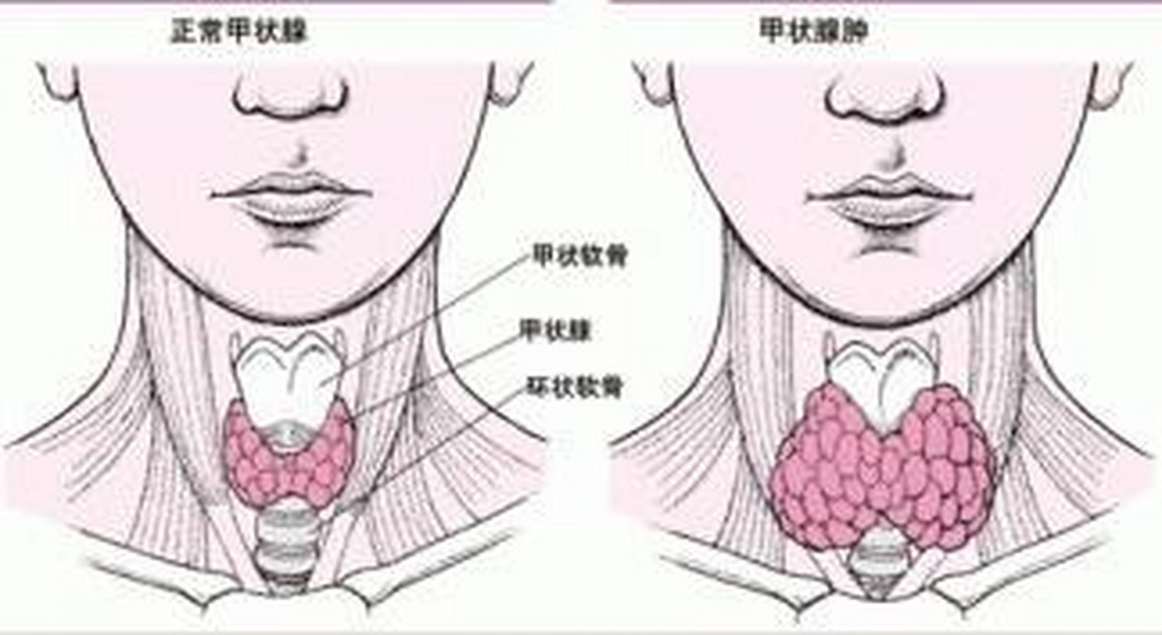 【甲状腺结节和甲状腺囊肿的区别】 其实,甲状腺囊肿是甲状腺结节的一