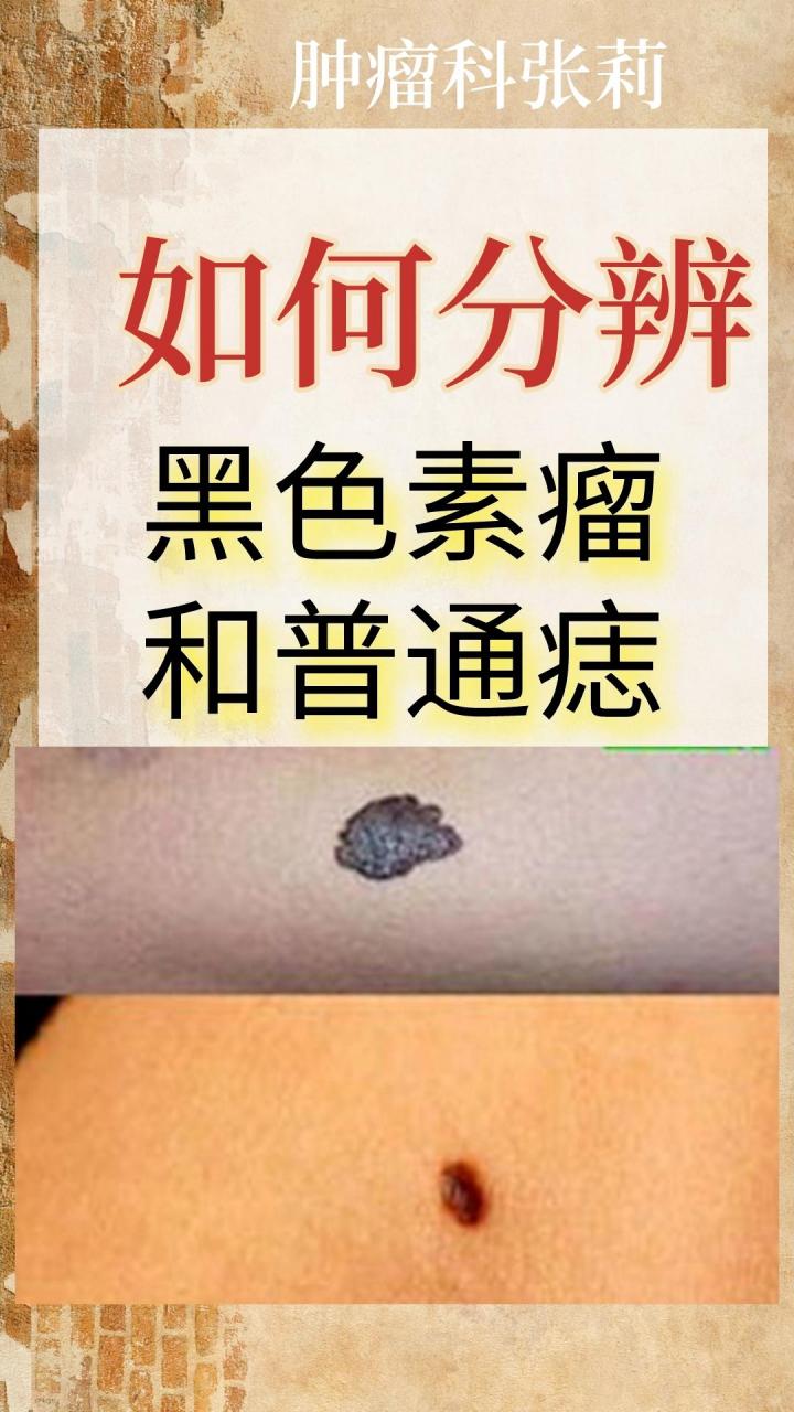 如何分辨黑色素瘤和普通痣# #黑色素瘤