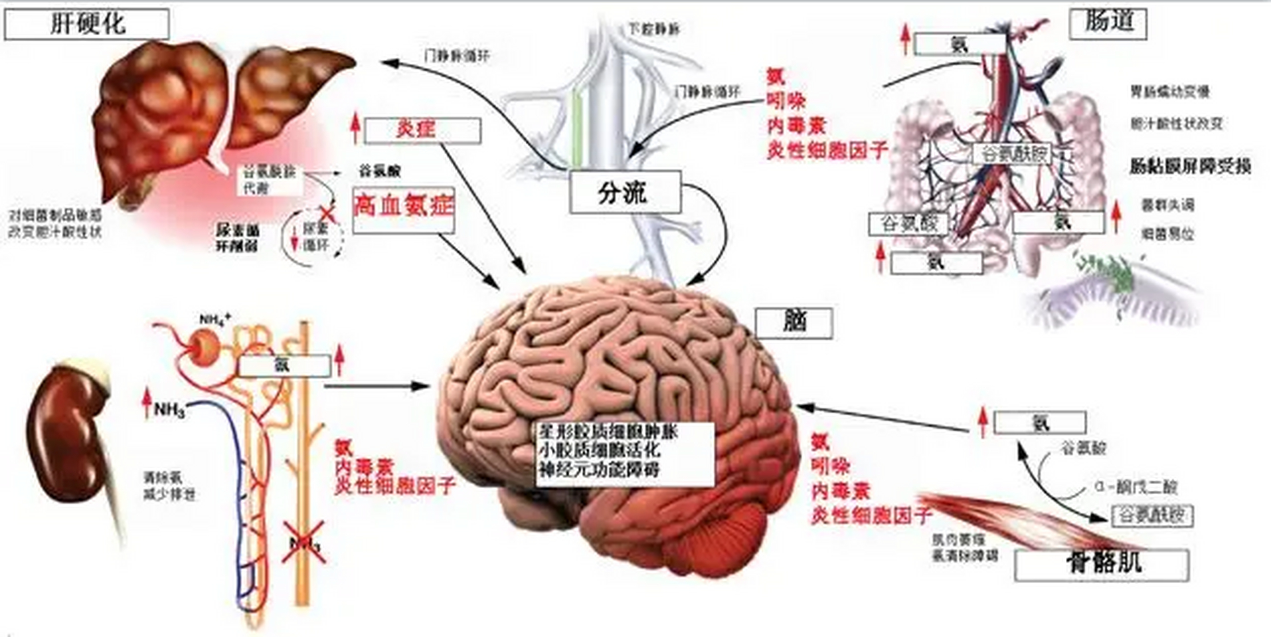 肝性脑病的发病机制图片