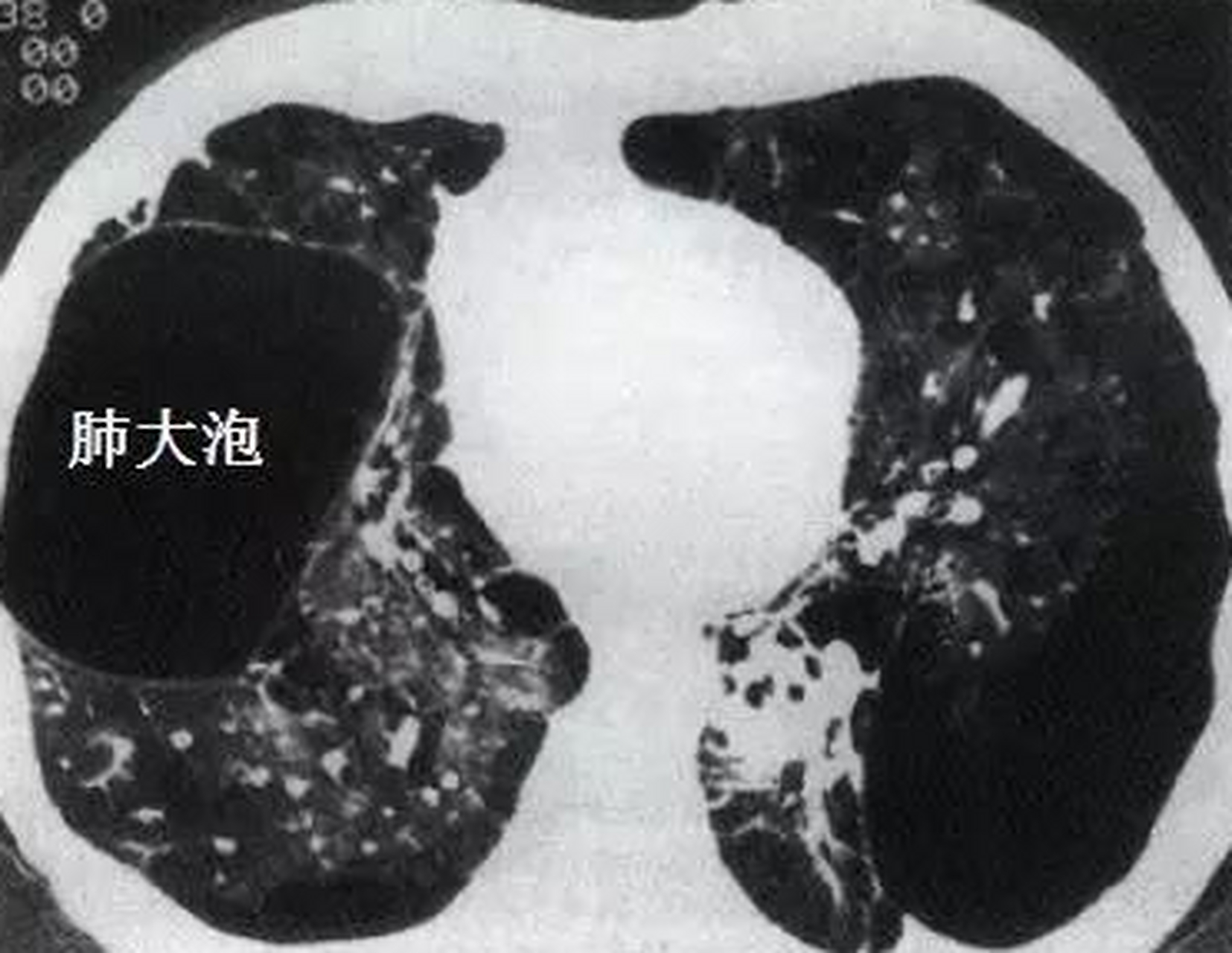 肺大泡能自行恢复吗?