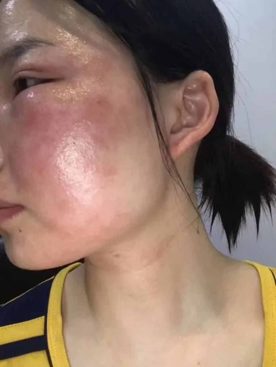 如果想要恢复到正常皮肤,需要采取以下措施:  1.停止使用激素类药物.