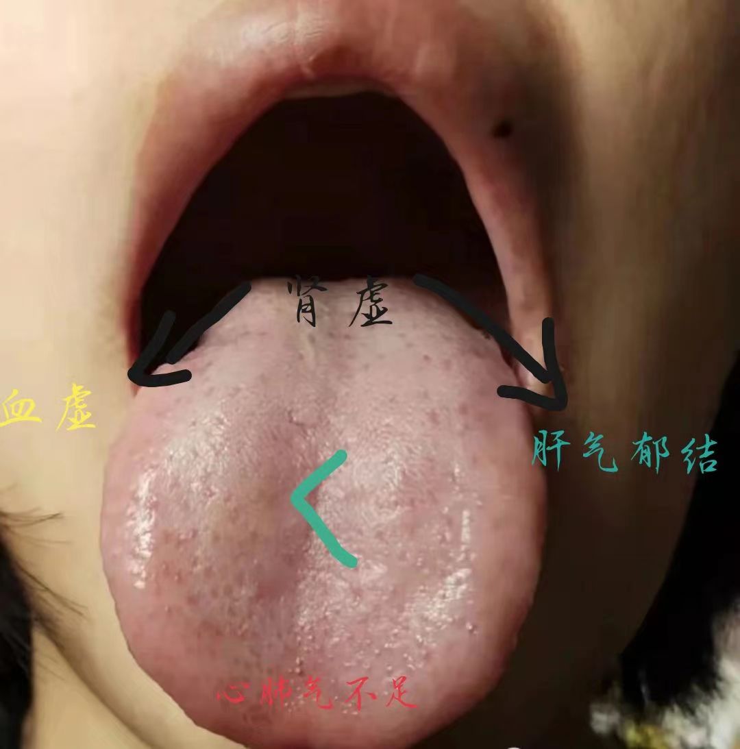 老王教你看舌头 我们一起来看这个患者发来的舌象肾虚血虚心肺气