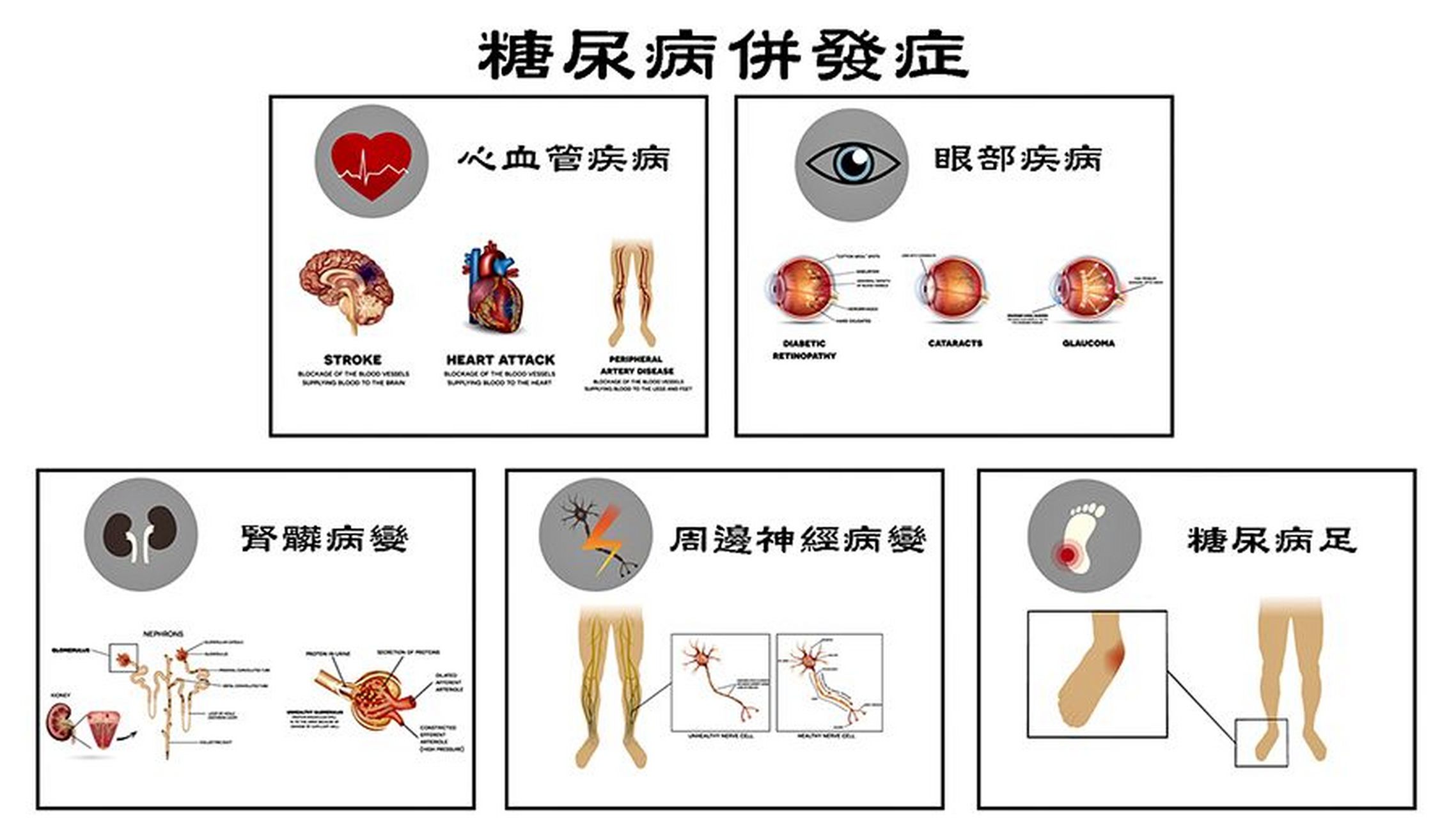 糖尿病患者若出现这些信号,并发症已经来了  糖尿病并不可怕,可怕的是