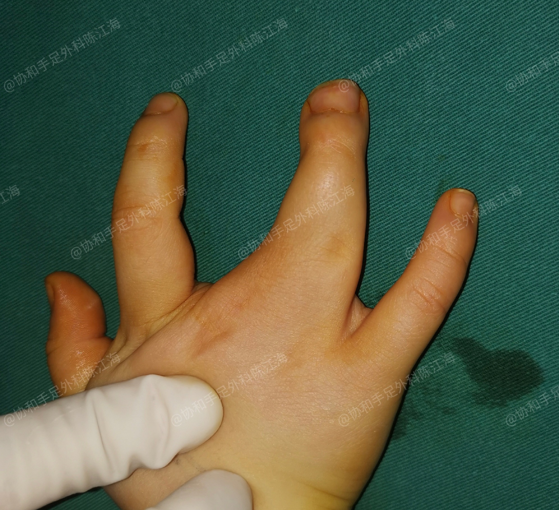 我猜,他年后肯定要去上学的, 因为手上的束缚已经