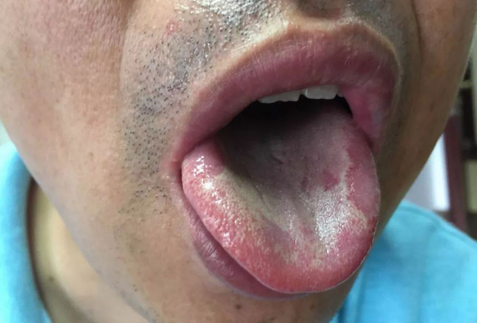 这个粉丝的舌头,是比较典型的舌边剥苔 他这个舌质,是偏红的,舌苔是薄