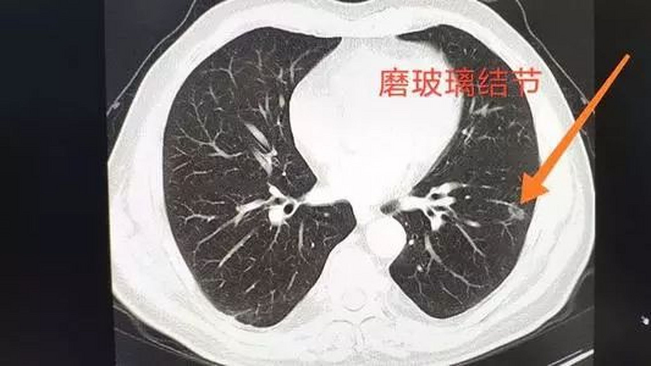 听郭医生详细说,不要再被谎言误导了,很多肺结节患者,都深受其害.