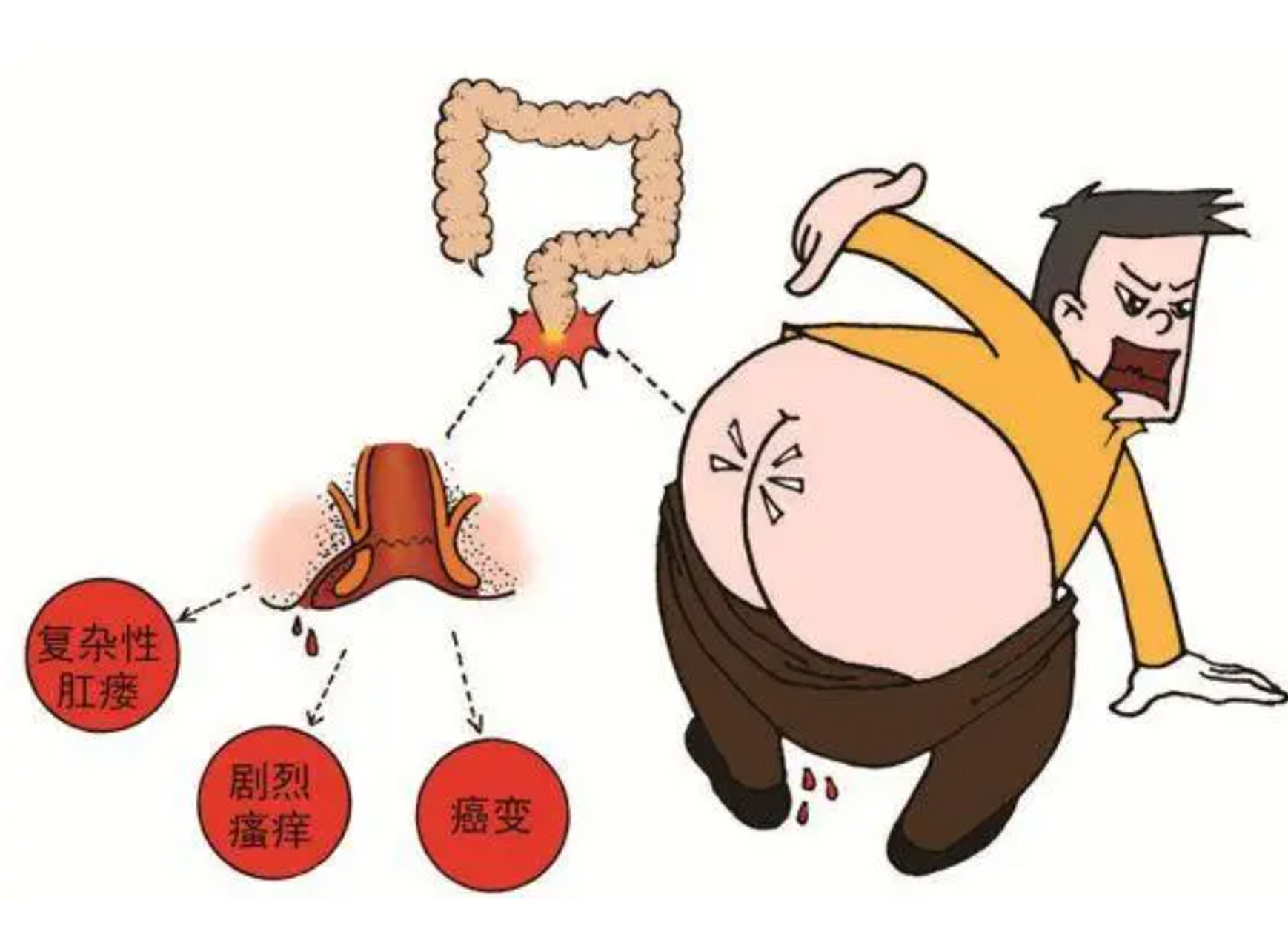 高位肛瘘和低位肛瘘分别采用什么方法治疗? 如果弄明白了肛瘘分类为什